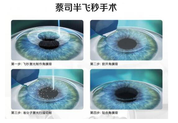 準(zhǔn)分子激光手術(shù)到底是怎么治 愈你的眼睛的？