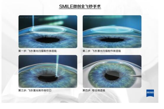 準(zhǔn)分子激光手術(shù)到底是怎么治 愈你的眼睛的？