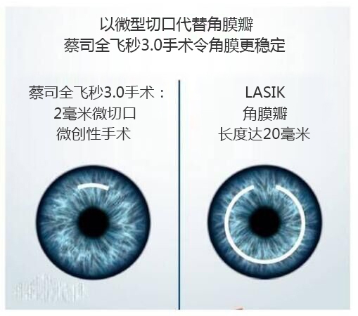 做完近視手術(shù)要休息多長時(shí)間？需要住院嗎？